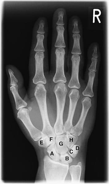 Radiograph of a human hand