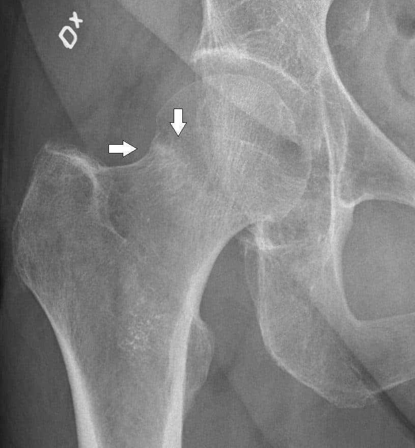 Radiograph of a hip fracture