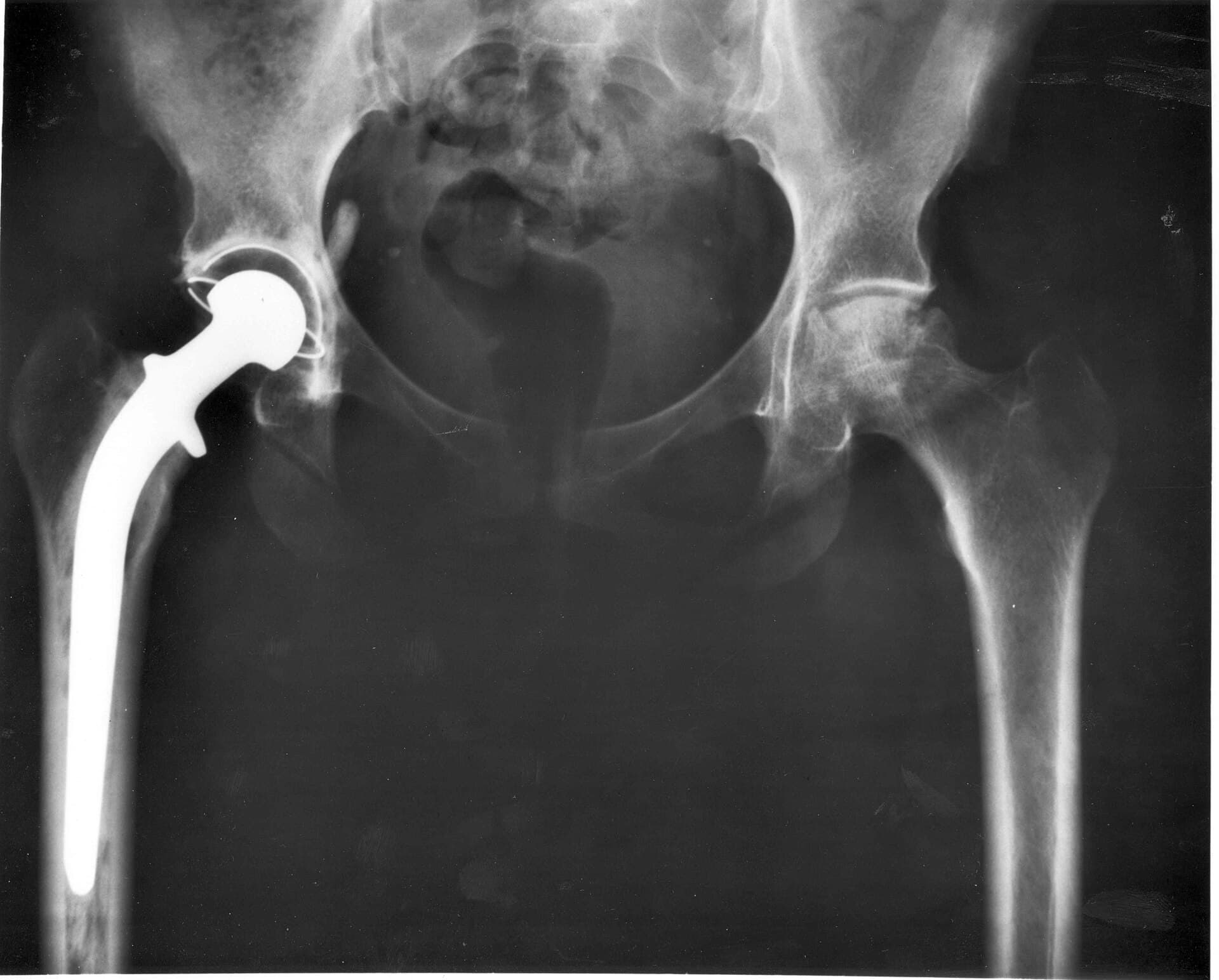 Post-operative hip replacement X-ray — the style of clinical imaging covered in the OrthoPrep question bank